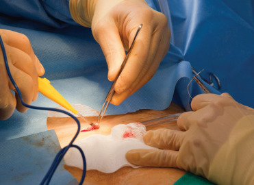 Suture Removal: How to Code