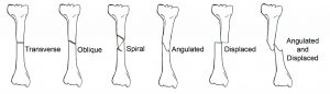 Fractures 101: Let’s Cover The Basics - Aapc Knowledge Center