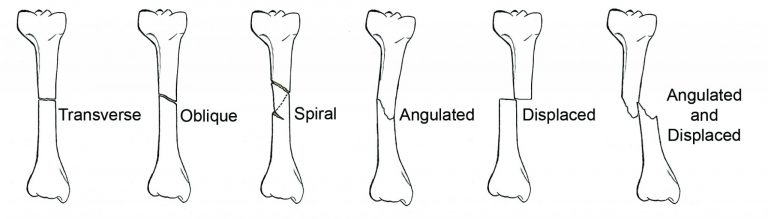 spiral-fracture-definition-causes-symptoms-treatment-recovery-time