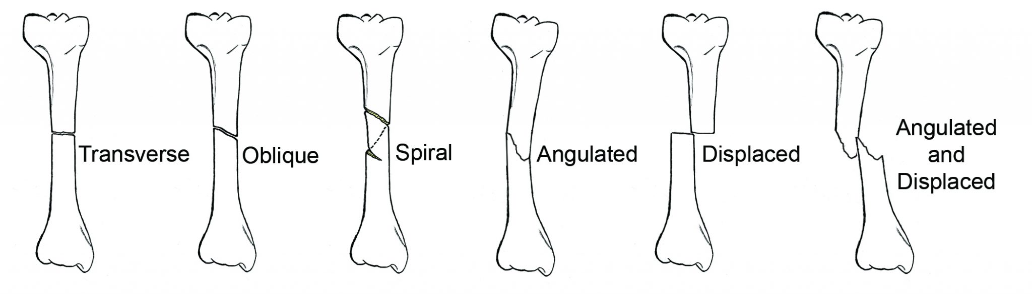 also called a closed fracture