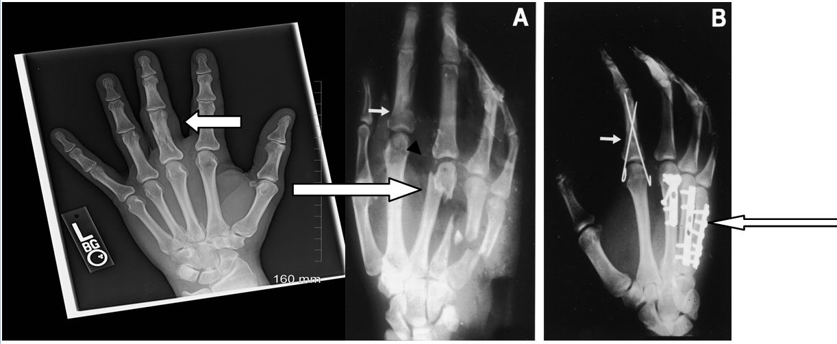 Fractures 101 Let s Cover the Basics AAPC Knowledge Center