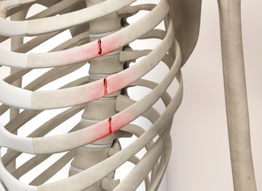 Reporting Rib Fracture Treatment in 2015 - AAPC Knowledge Center