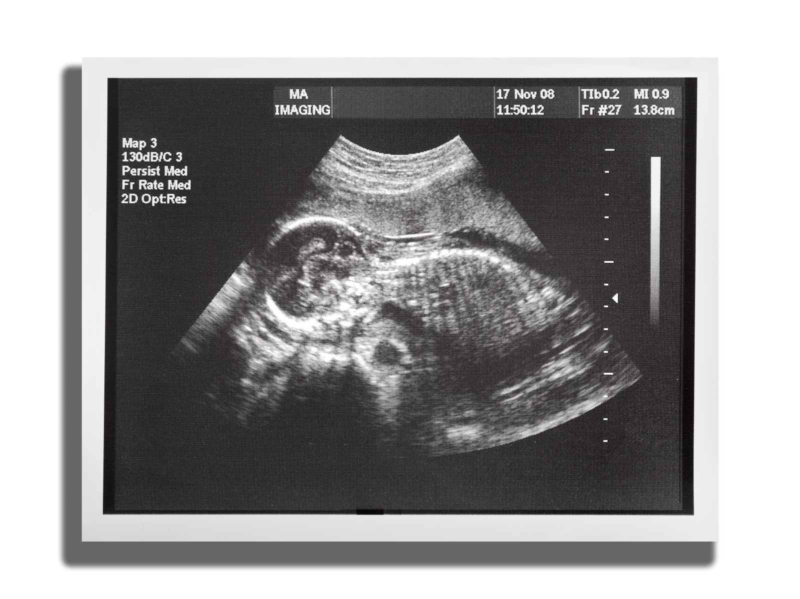 Us obstetric nuchal dating scan in Maracaibo