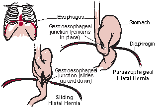 Hernias of the Abdominal Wall - Gastrointestinal Disorders - Merck