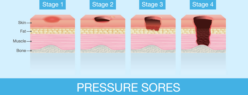 stage 1 pressure ulcer