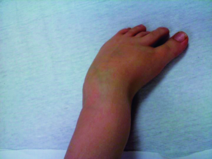 Clubfoot Deformities Get a Full Range of Understanding - AAPC