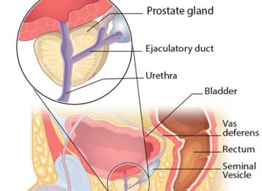 screening prostate cancer icd 10)