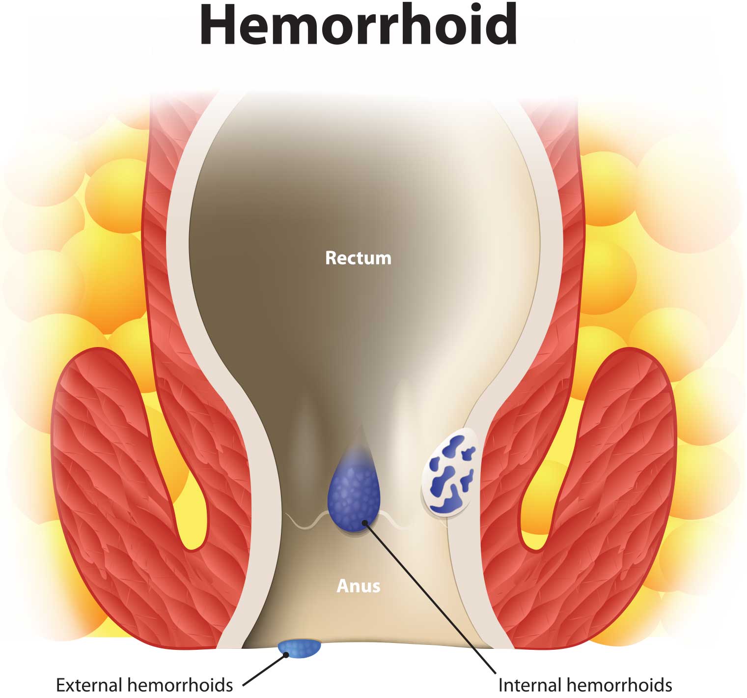 Until recently, providers using Ultroid® didn’t have a clear code choice to report Ultroid® treatment as a nonsurgical method to treat hemorrhoids.