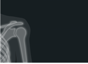 The New Year Brings Changes to Shoulder Arthroscopy in the NCCI Manual The New Year Brings Changes to Shoulder Arthroscopy in the NCCI Manual