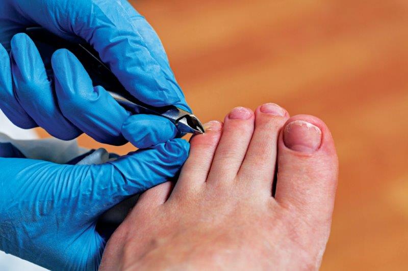 Toenail Infections | Nail Fungus Infection | Infected Toenail