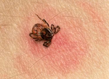 CDC: Don't Report "Chronic Lyme Disease"