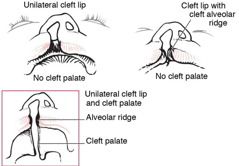 Make Cleft Lip and Palate Repair a Priority in July AAPC Knowledge Center