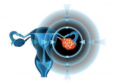 Keep Up with Current Treatment for Ovarian Cancer