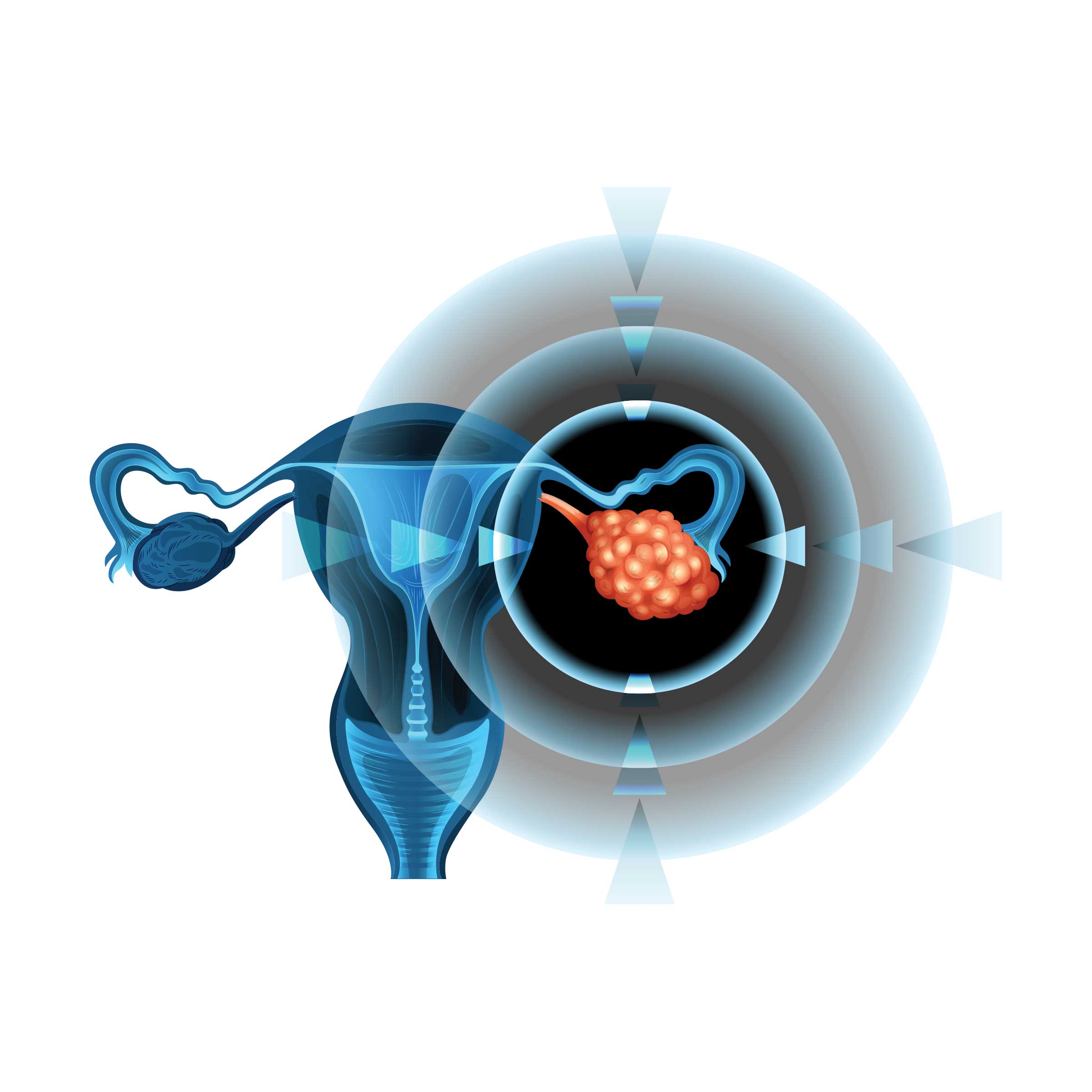 Keep Up with Current Treatment for Ovarian Cancer - AAPC Knowledge Center