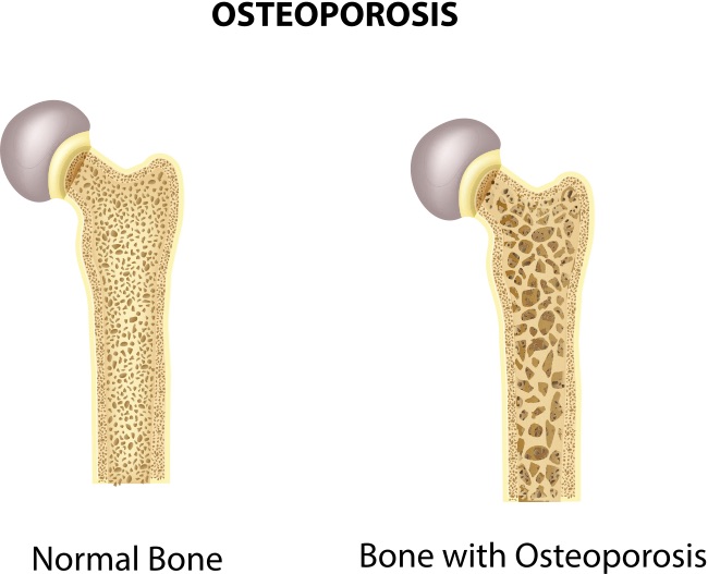Osteoporosis ICD10CM Coding AAPC Knowledge Center