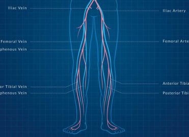 Get a Leg Up on Lower Extremity Revascularization Coding