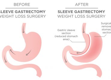 vertical banded gastroplasty before and after