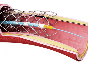 Order Up Concise Vascular Catheterization Coding Order Up Concise Vascular Catheterization Coding