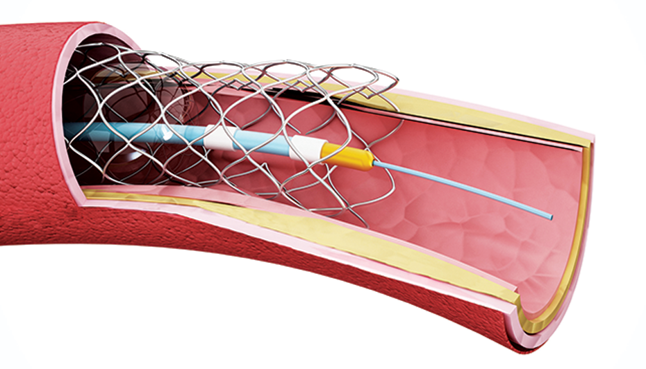 Order Up Concise Vascular Catheterization Coding AAPC Knowledge Center