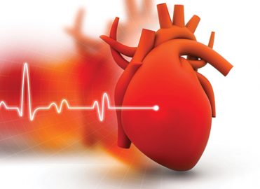 Don’t Miss a Beat when Coding Myocardial Infarction