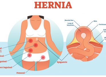 Tep Repair Of A Bilateral Obturator Hernia Sages Abstract Archives