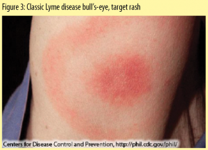 Bull's-eye rash