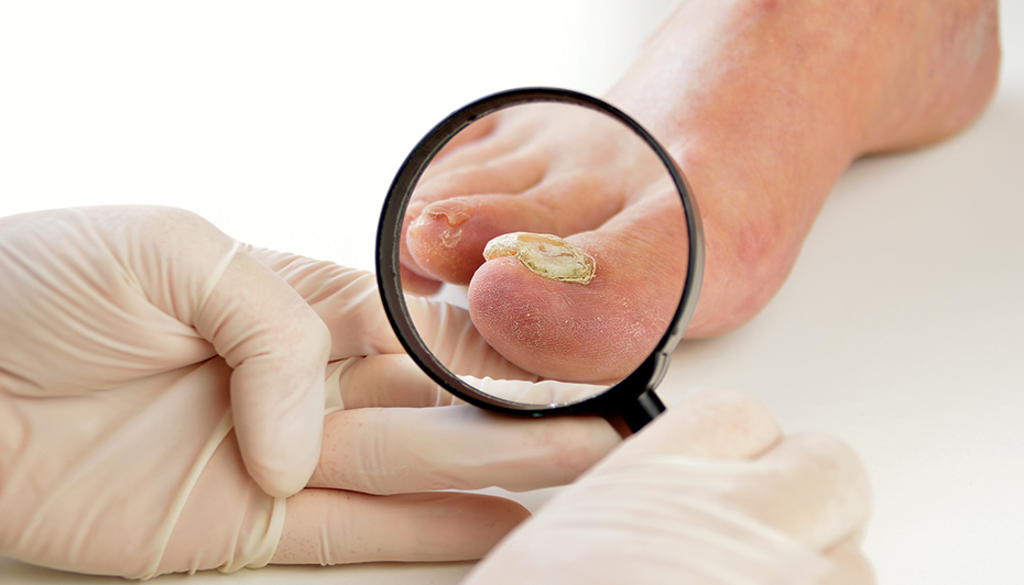 onychomycosis of toenail icd 10)