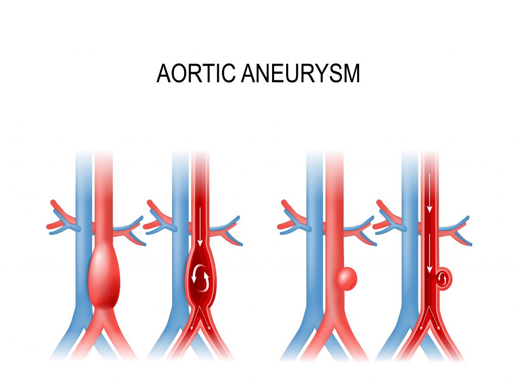 Abdominal Aortic Aneurysm Types 7968