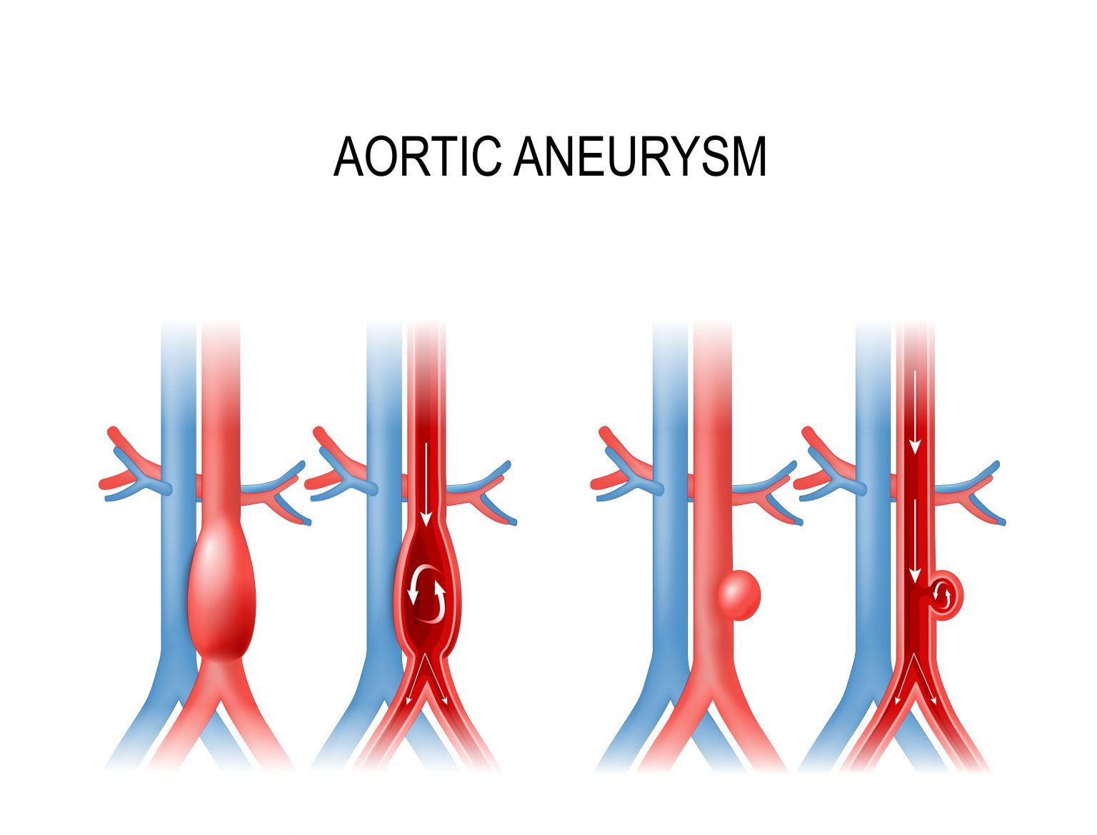 abdominal-aortic-aneurysm-types