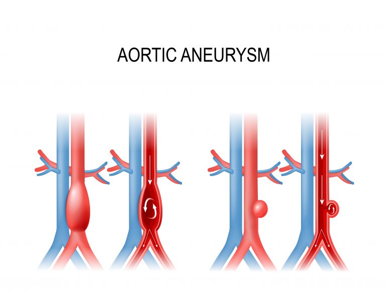 recommendations-for-abdominal-aortic-aneurysm-screening-aapc