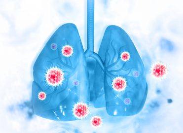 What is Lobar Pneumonia?