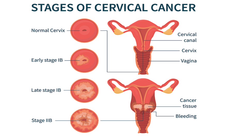 Icd 10 ca cervix