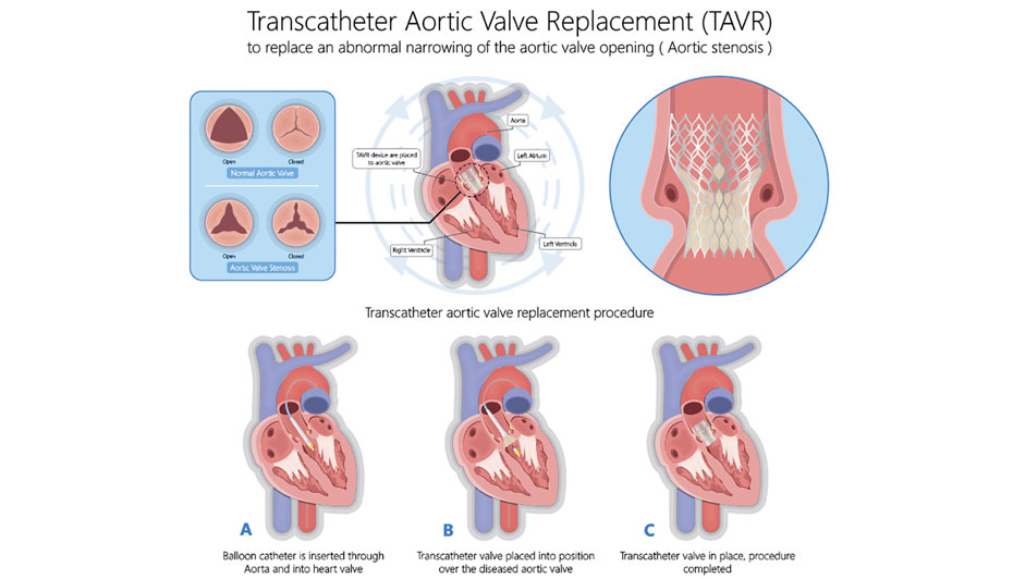 Get to the Heart of Coding TAVR AAPC Knowledge Center