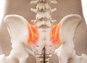 ○○ The Evolution of the Sacroiliac Joint Fusion - AAPC