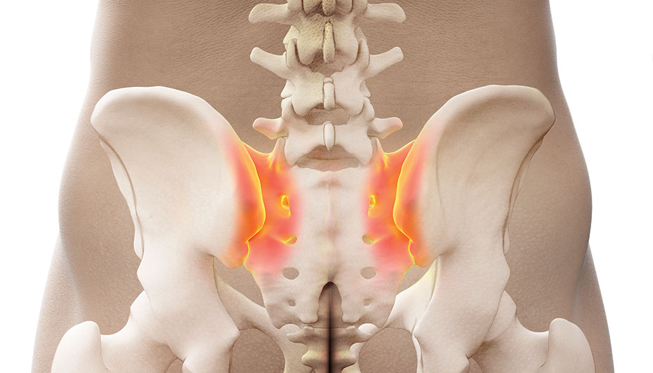 The Evolution of the Sacroiliac Joint Fusion - AAPC Knowledge Center